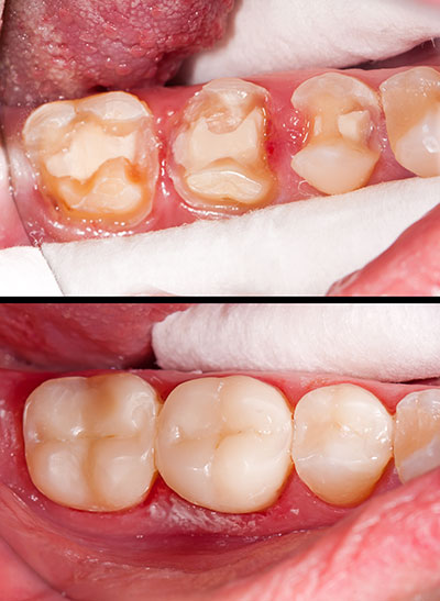 The image displays a dental procedure with a patient s mouth open, showcasing an oral cavity with teeth undergoing treatment, likely a cleaning or repair process, against a backdrop of a medical setting.