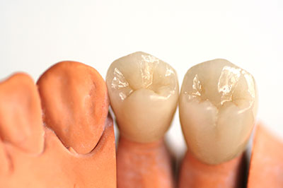 This is a close-up photograph of two rows of artificial teeth, with the upper row appearing to be intact with a full set of teeth, while the lower row is missing a tooth, showcasing dental implants.