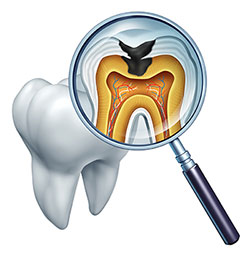 The image shows a magnified view of a dental X-ray with a tooth highlighted, featuring an internal view of the tooth s root and cavity, surrounded by bone tissue, viewed through a magnifying glass.