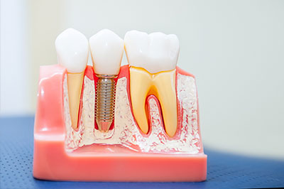 The image shows a dental model with several teeth, some with visible cavities, placed on a pink plastic base, with a metal screw visible through one of the artificial teeth.