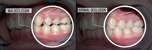 The image displays two photographs side by side, showing a person s teeth before and after a dental procedure, highlighting the transformation from malocclusion to normal occlusion.