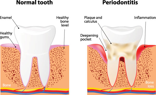 The image presents a detailed illustration of the stages of periodontitis, from normal tooth structure to advanced bone loss around the teeth.