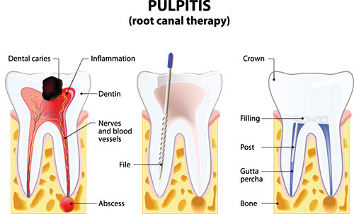 The image depicts a medical illustration showing a pulpitis condition with a root canal therapy diagrammed on teeth, highlighting dental caries, inflammation, and the procedure s process.