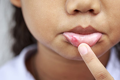 The image depicts a young individual with a noticeable red bump on their lower lip, holding their finger near it.