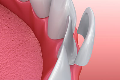 The image shows a close-up view of a dental implant with a screw visible on its surface.