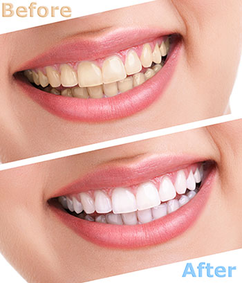 The image shows a woman s smile before and after teeth whitening treatment.