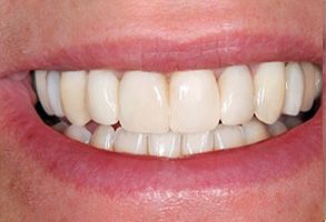 The image shows a close-up of a person s smile with straight white teeth, displaying good oral hygiene.