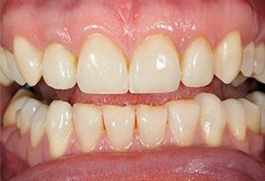The image shows a close-up view of a person s teeth with a focus on their lower front teeth, which are yellowed and have some staining.