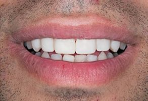 The image shows a close-up of a person s smiling face with teeth, lips, and a part of their chin visible, against a plain background.