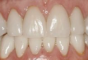 The image shows a close-up view of a person s teeth with a focus on a dental implant.