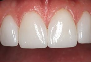 White teeth with gumline detail on a person s face.