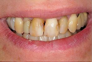 The image shows a close-up of a person s teeth with significant discoloration, likely due to staining or decay, and they are smiling.